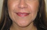 mole removal from upper lip using plastic surgery techniques