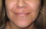 mole removal from upper lip using plastic surgery techniques
