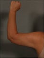 43 Year Old Female with skin laxity and excess heaviness upper arms