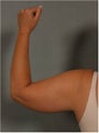 43 Year Old Female with skin laxity and excess heaviness upper arms