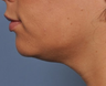 Ulthera