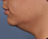 Ulthera