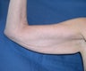 Patient Received Arm Lift