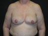 Breast reconstruction - Implants