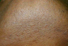 Laser Hair Removal