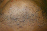 Laser Hair Removal