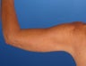 48 Year Old Weight Loss Patient with Arm Laxity