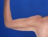 48 Year Old Weight Loss Patient with Arm Laxity