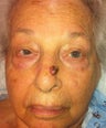 Nasal tumor/mole removal using plastic surgery techniques