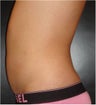 SmartLipo MPX