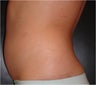 SmartLipo MPX