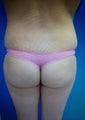 20 year old female treated with Brazilian Butt Lift Procedure