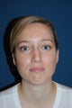 Female with Eyelid Surgery