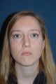 Female with Eyelid Surgery