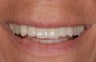 Missing and broken teeth for this patient were replaced implants and crowns.