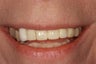 Missing and broken teeth for this patient were replaced implants and crowns.