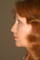 Chin Implant