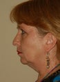 Chin Implant