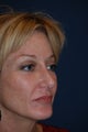 Female with Cheek Implants