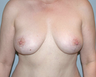 Breast Lift