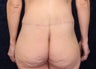 40 Year Old Woman After Gastric Bypass