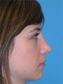 Septorhinoplasty: Before and After