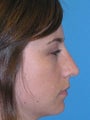 Septorhinoplasty: Before and After