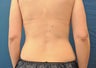 CoolSculpting