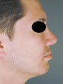 Male Chin Implant