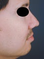 Male Chin Implant