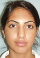 21 year old rhinoplasty