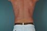 Liposuction
