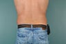 Liposuction