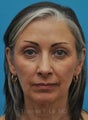 Aging face rejuvenation with Botox and Filler