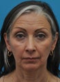 Aging face rejuvenation with Botox and Filler