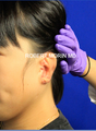Ear Reconstruction: Microtia