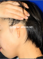Ear Reconstruction: Microtia