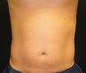 CoolSculpting