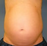 CoolSculpting