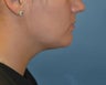 Neck Liposuction