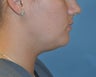 Neck Liposuction