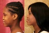 African-American Rhinoplasty