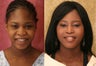 African-American Rhinoplasty
