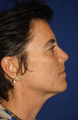 Laser Treatment