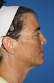 Laser Treatment