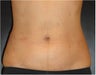 SmartLipo MPX