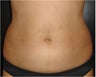 SmartLipo MPX