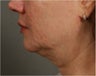 57 year old female with jowls and neck laxity after Smart Lipo performed by Dr. Ran Rubinstein, Newburgh, New York
