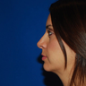 Rhinoplasty