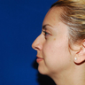 Rhinoplasty